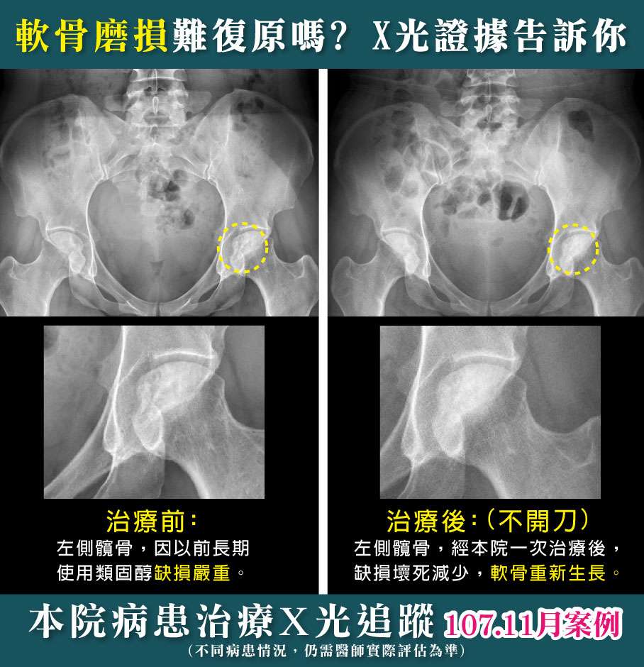 PRP治療前後X光對比照