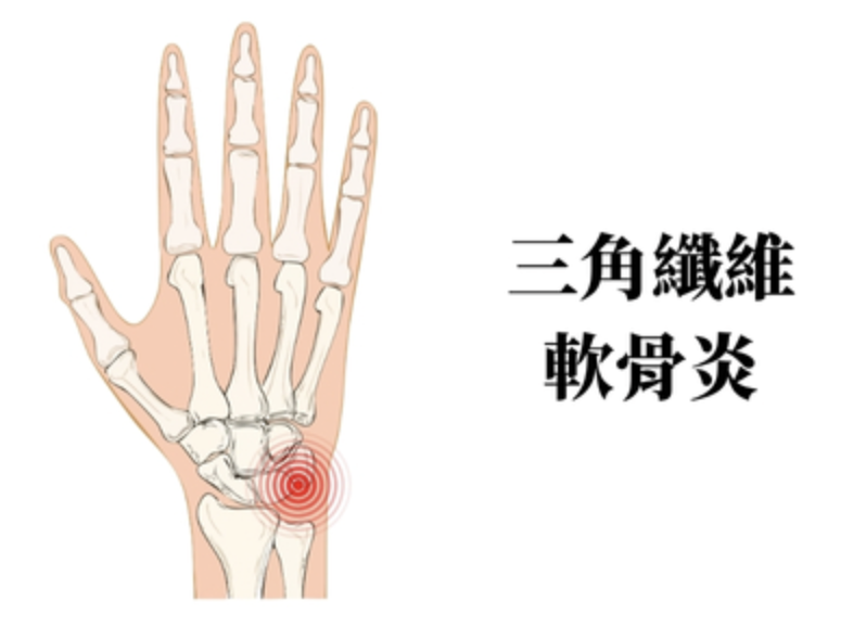 三角纖維軟骨炎