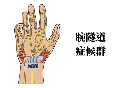 腕隧道症候群