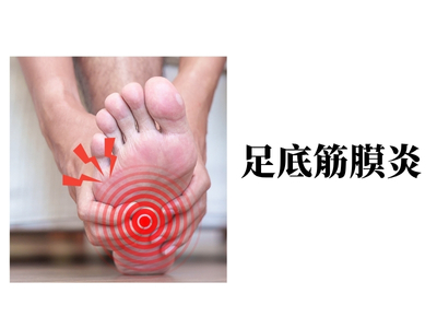足底筋膜炎