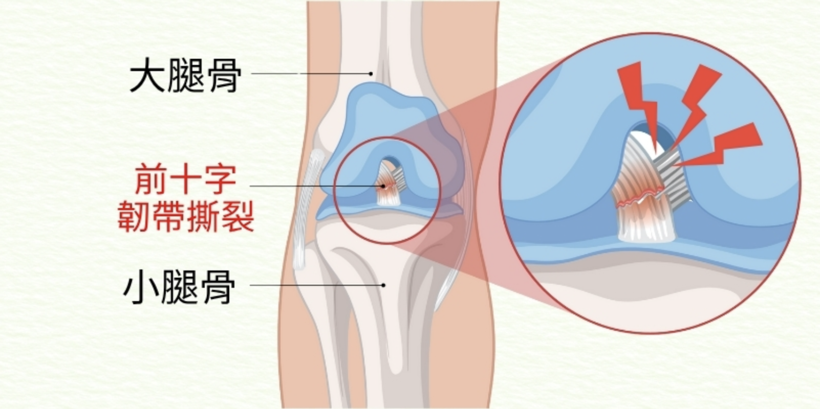 前/後十字韌帶撕裂