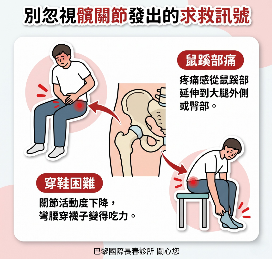 退化性髖關節炎的成因、症狀、檢查與治療全解析：不動刀的新選擇