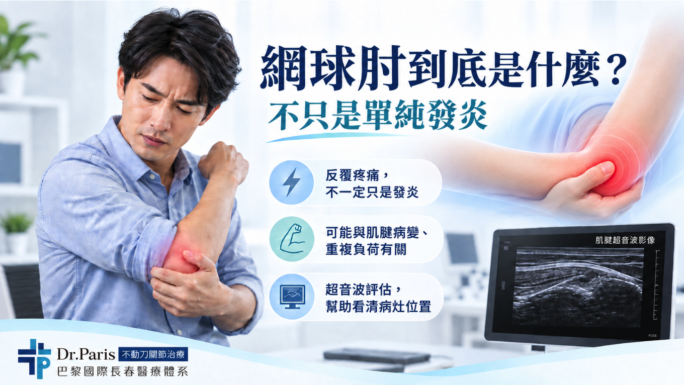 網球肘是什麼?網球肘又稱外側肘肌腱病變,常見於肱骨外上髁附近的伸肌肌腱,可能出現手肘外側疼痛、提重物無力及工作或運動後反覆不適。巴黎國際長春診所網球肘衛教圖說明,慢性手肘痛不一定只是發炎,也可能與肌腱結構改變及重複性負荷有關,並可透過肌腱超音波評估觀察伸肌肌腱與疼痛部位,協助醫師進一步判斷手肘疼痛來源。